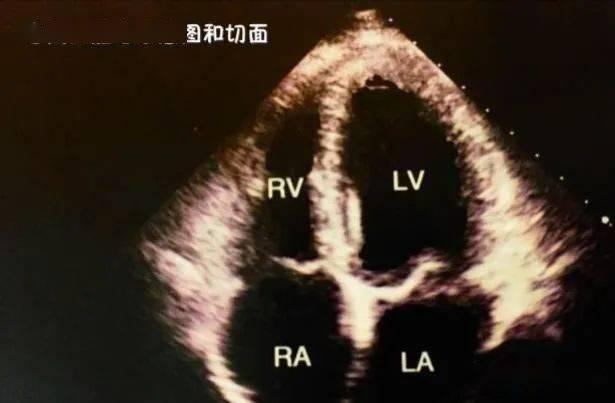 心脏彩超教学视频