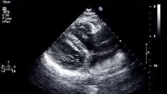 心脏彩超教学视频